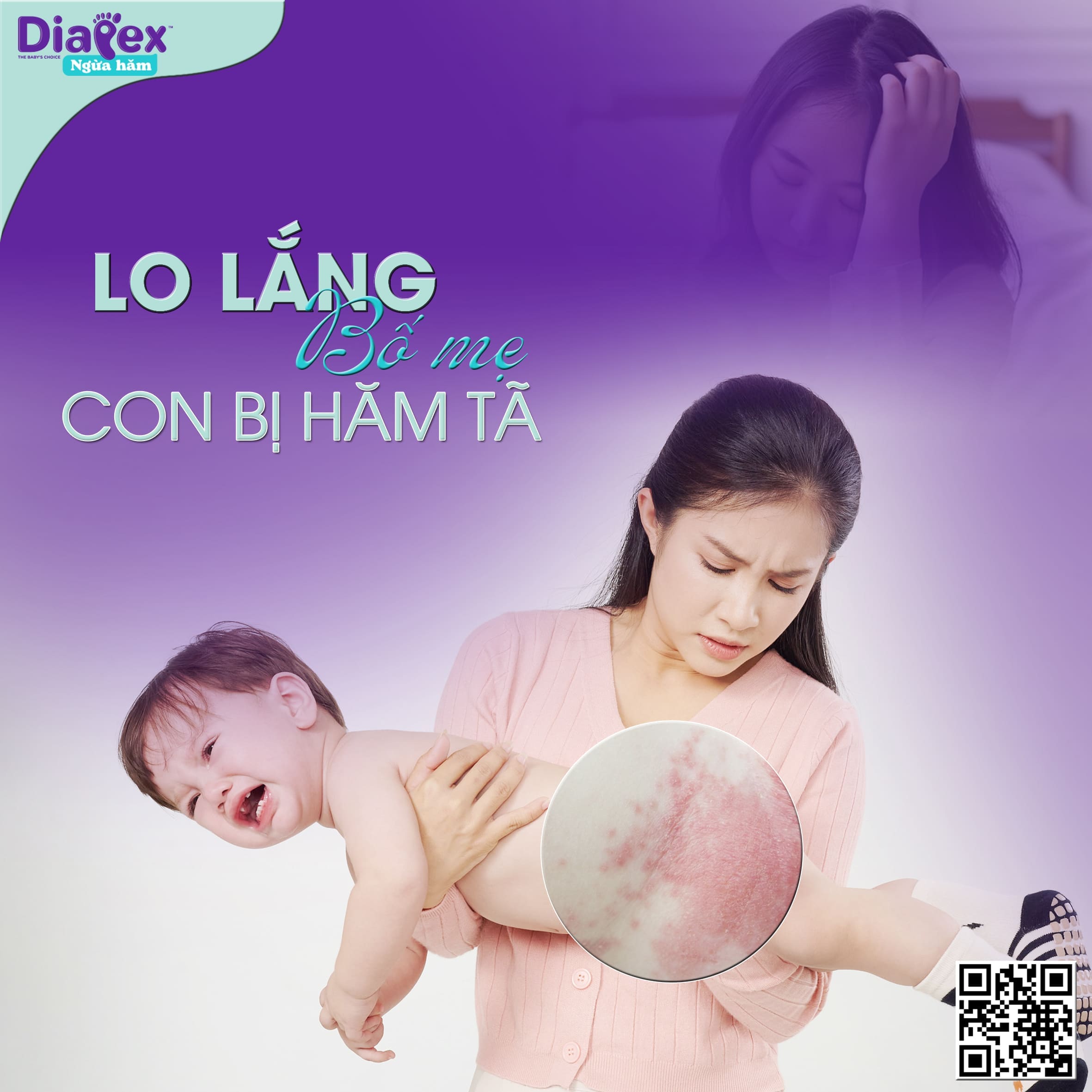 Phân biệt hăm tã và dị ứng bỉm